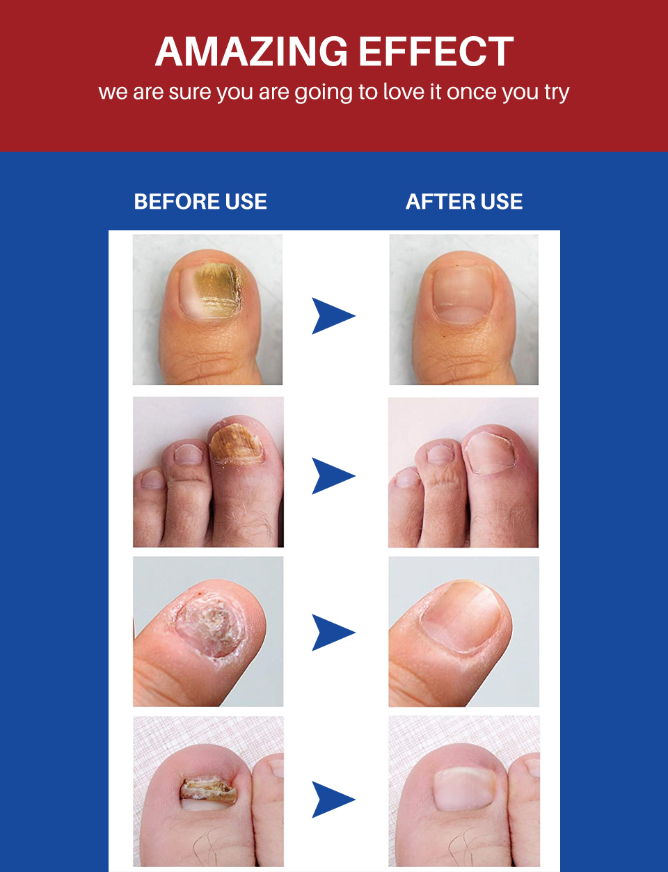 OEM/ODM Herbal Anti Fungal Nail Infection Foot Toe Nail with Fungus Treatments Oil Liquid  for Fungal Nail from China supplier